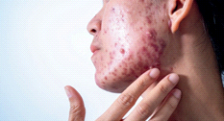 Gambar Kulit Berminyak Hingga Berjerawat